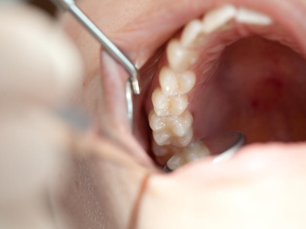 mundhöhlenkrebs: tumor kann sich in umgebung ausbreiten und äußere haut durchbrechen
