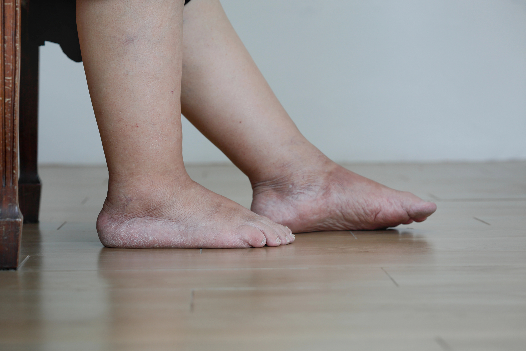 inchaço nas pernas pode indicar problema grave de saúde