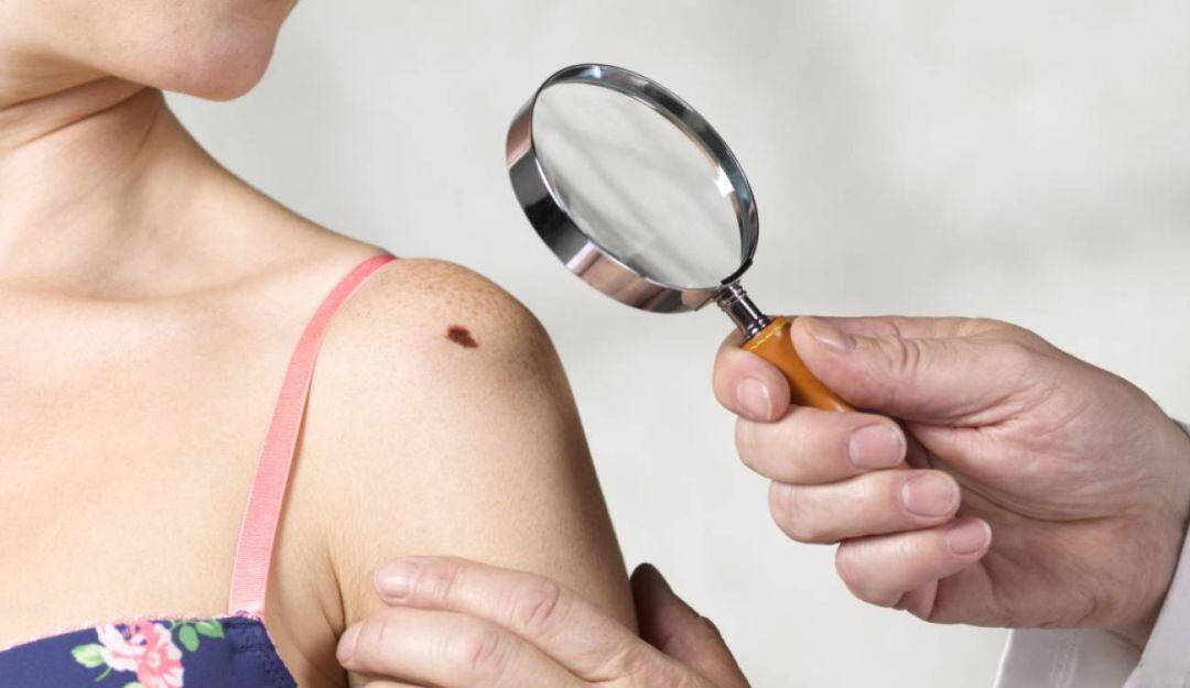 ¿cómo comienza el cáncer en la piel? así podría saber si una mancha es maligna