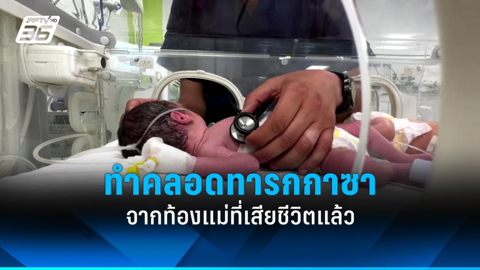 ทีมแพทย์ในฉนวนกาซาทำคลอดทารกจากร่างแม่ที่เสียชีวิตแล้ว