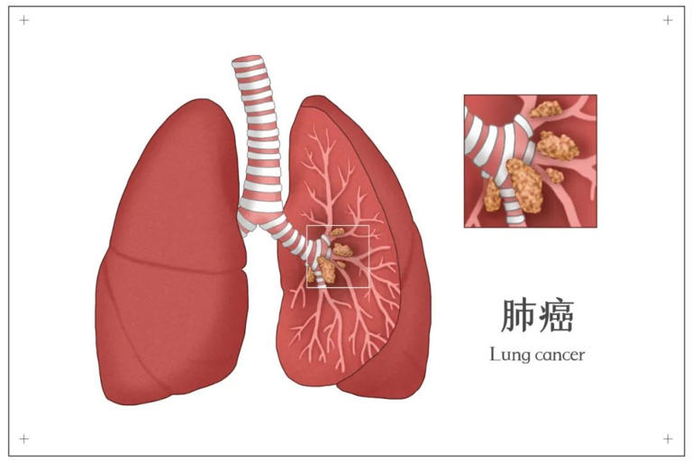青春有你3选手蒋智豪罹患肺癌，揭秘肺癌预警信号与高危人群筛查方法！