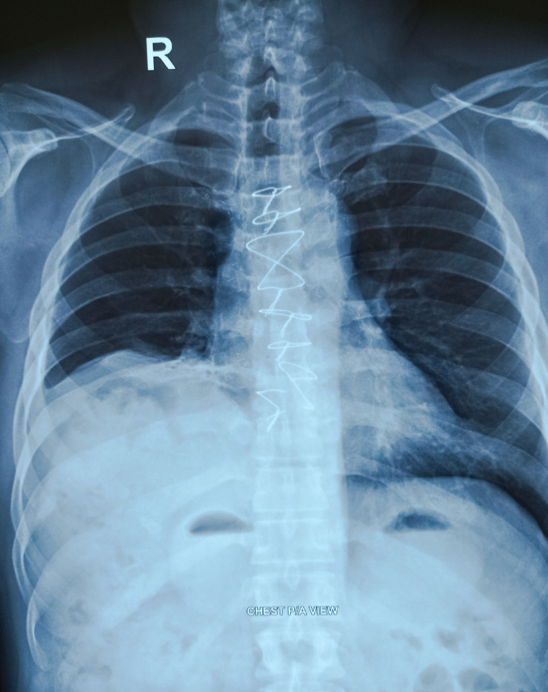Was ist Fibrodysplasia ossificans progressiva (FOP)?