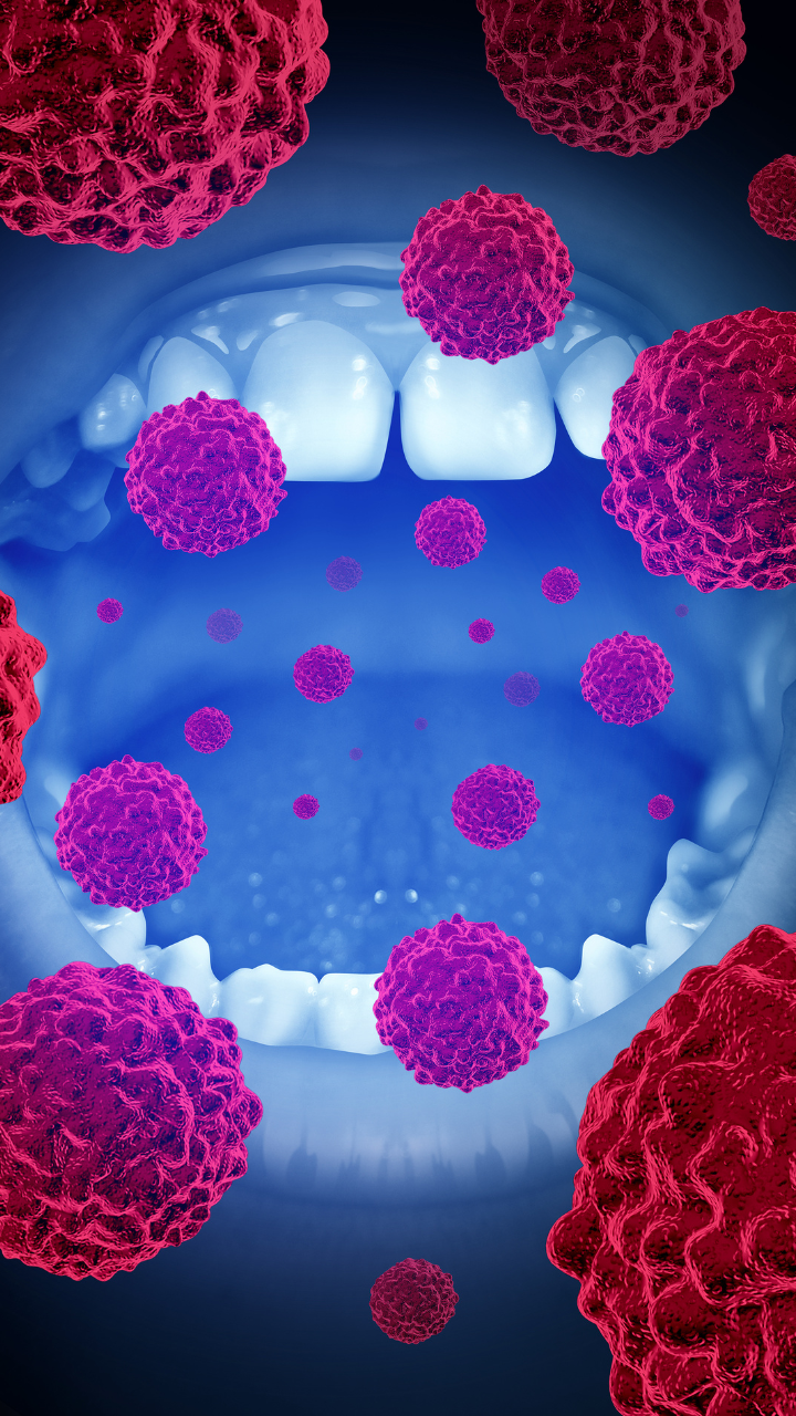 8 early signs of oral cancer common in patients