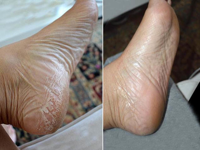 I tried the wildly popular Baby Foot peel — and the results were incredible