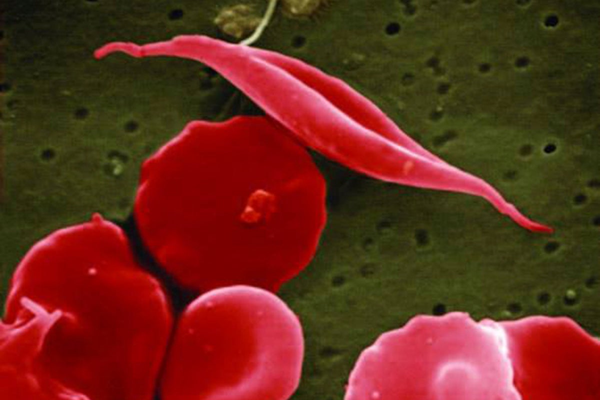‘life-changing’ sickle cell drug approved for nhs roll-out after patient-led campaign