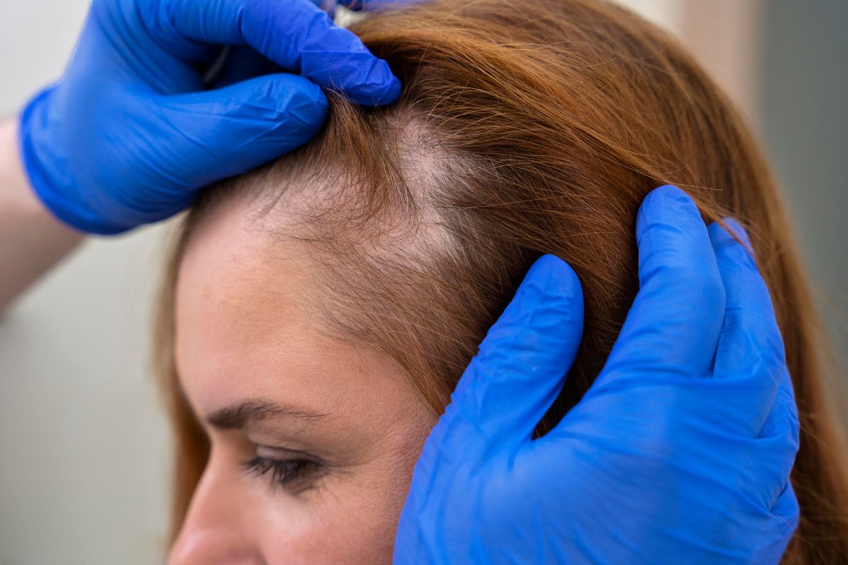 desvende os mitos da queda de cabelo com especialistas