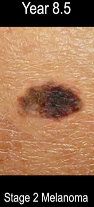 alarming time-lapse reveals how tiny 'dark patch' becomes melanoma
