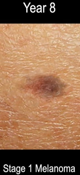 alarming time-lapse reveals how tiny 'dark patch' becomes melanoma