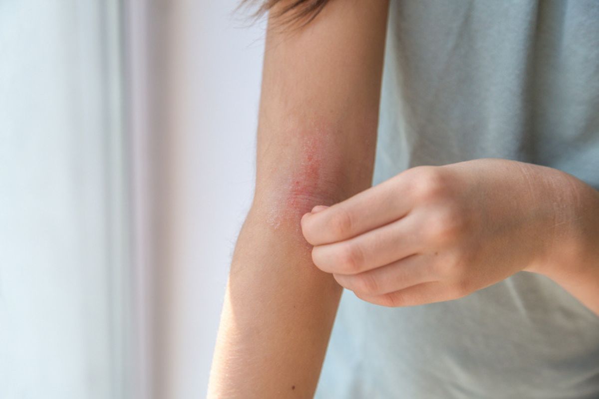 dermatitis atópica: 6 hábitos para evitar o reducir un brote de esta molesta afección