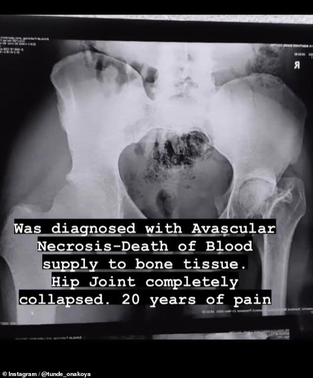 Last year Tunde announced that he had been diagnosed with Avascular Necrosis in his right hip joint (pictured: an x-ray of Tunde's hip joint)