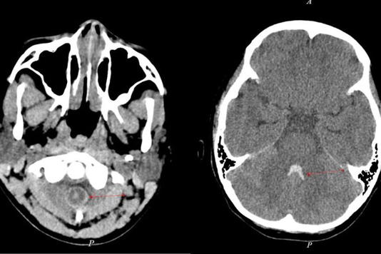 Kết quả CT cho thấy hình ảnh xuất huyết trong não thất và khoang dịch não tuỷ ở cột sống cổ của bệnh nhi. Ảnh: Bác sĩ cung cấp