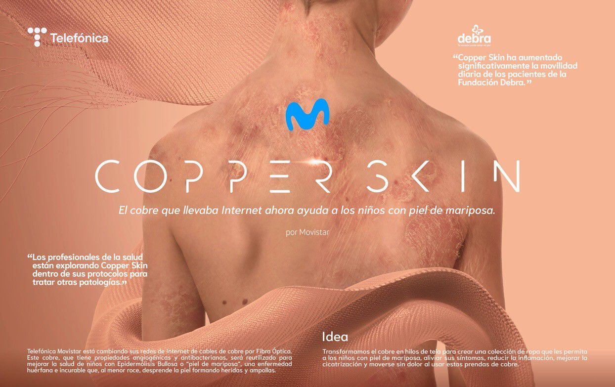 combatir la “piel de mariposa”, enfermedad huérfana, es posible gracias al hilo de cobre