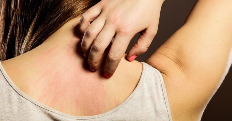 Mujer rascando su espalda por picadura de garrapata la cual puede causar rickettsia 