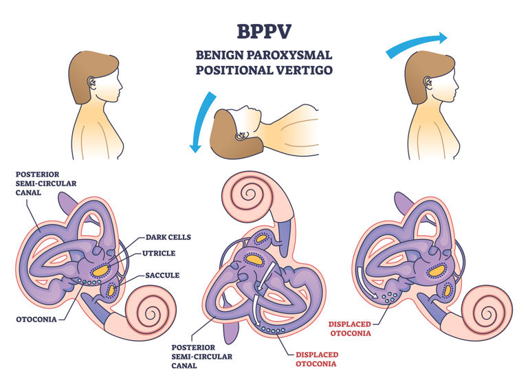 Feeling dizzy experts share how to tell which ear is causing vertigo