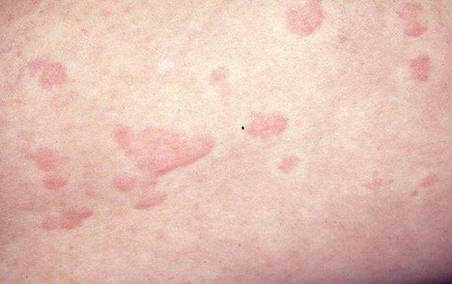 What is a mono rash?