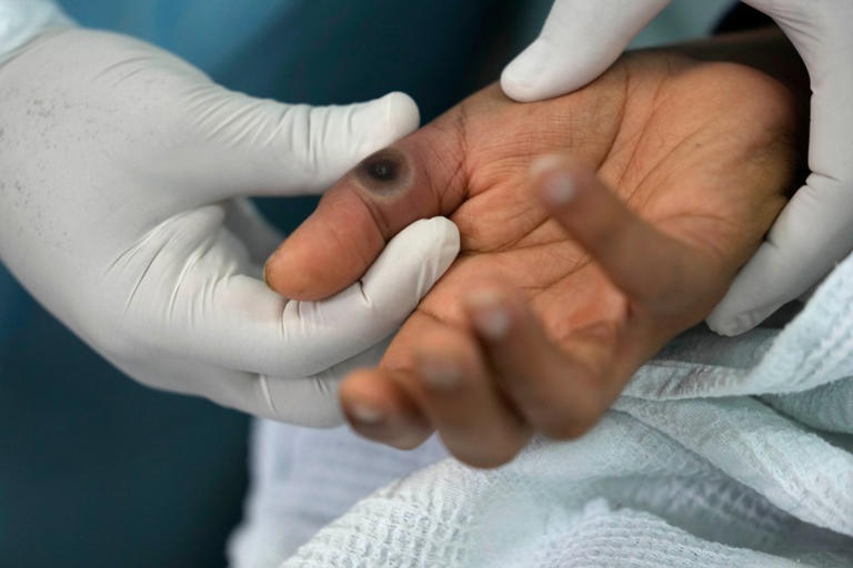 A doctor shows a sore on a patient´s hand caused by mpox at the Arzobispo Loayza hospital in Lima, Peru, Tuesday, Aug. 16, 2022.