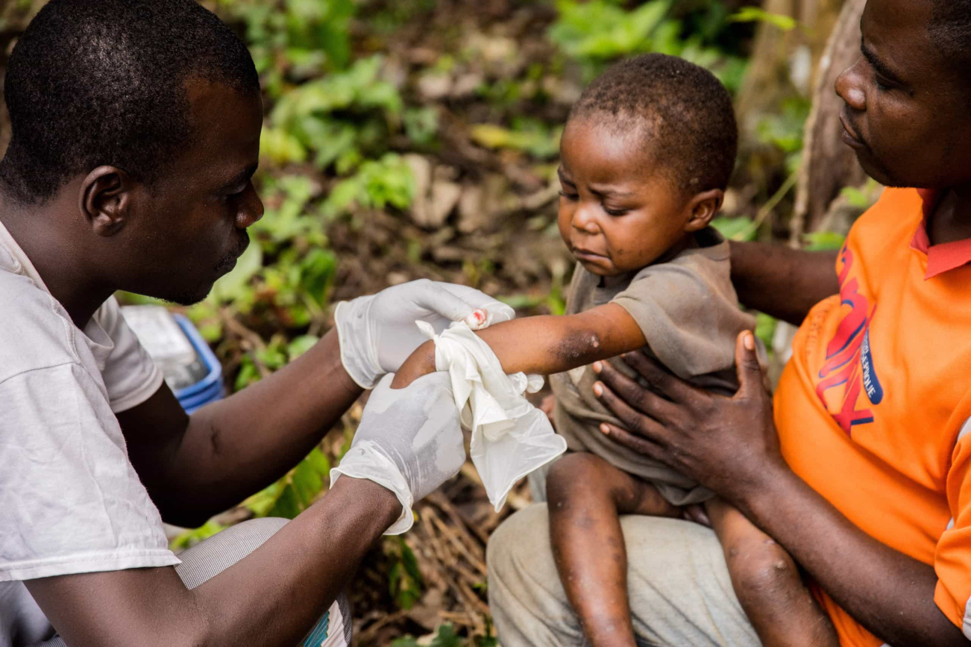 The United States’ first case of clade 1b mpox was detected in California