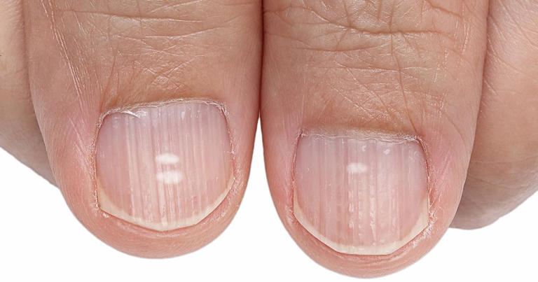 Say Goodbye To Unsightly Nail Ridges With These Game-Changing Tricks!