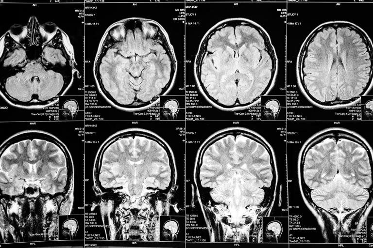 Not Everyone’s Brain Is Mature At Age 25. In Fact, Women’s Brains Tend