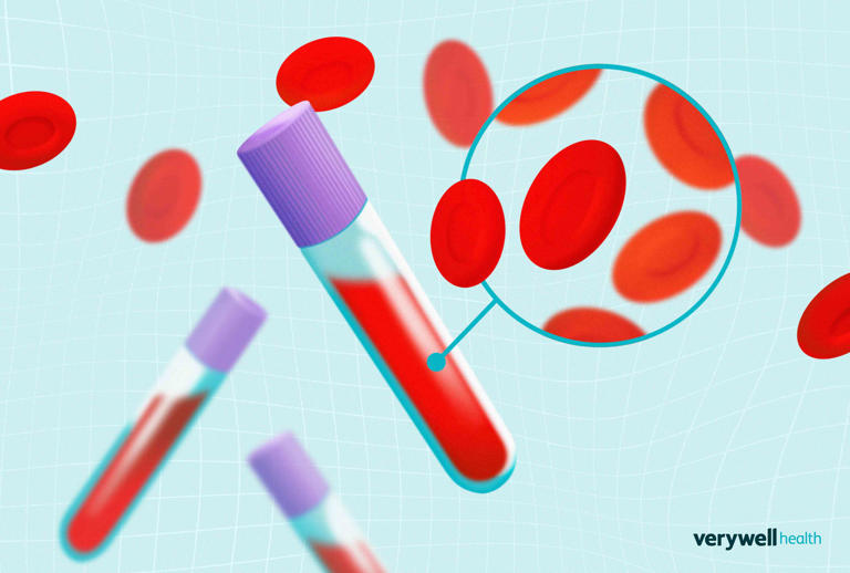 Mean corpuscular volume (MCV) blood test