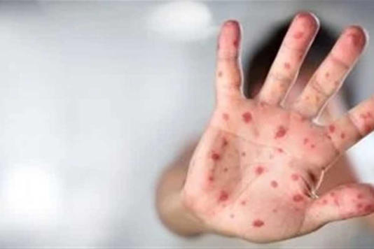 «خذ حذرك».. «الصحة» تكشف 6 طرق لانتقال جدري القرود من شخص لآخر
