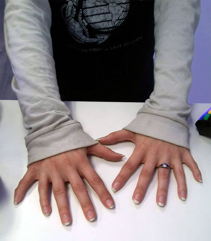 #30 Customer Came In And Let Me Take A Picture Of Her Hands That Had 6 Fingers On Each