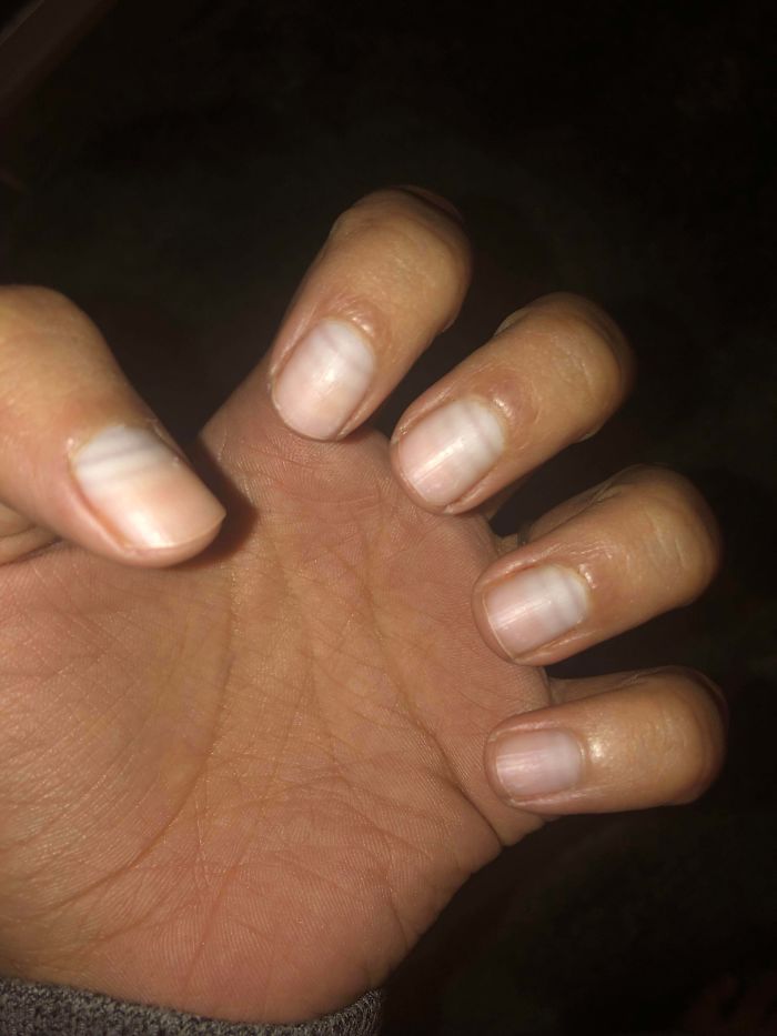 #49 You Can See Where My Nails Stopped And Started Growing Again Between Chemo Cycles