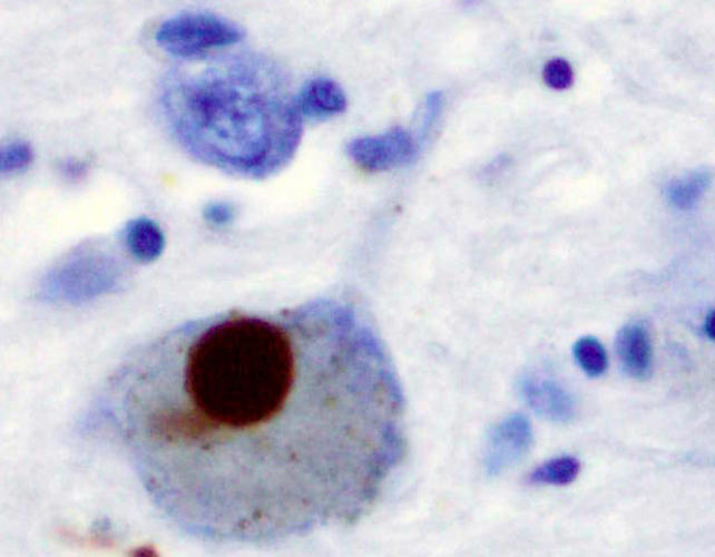 Alpha-synuclein shown by positive staining (brown) in a Lewy body in the substantia nigra of a patient with Parkinson's disease. ( Marvin 101/ CC BY-SA 3.0/ Wikimedia Commons)