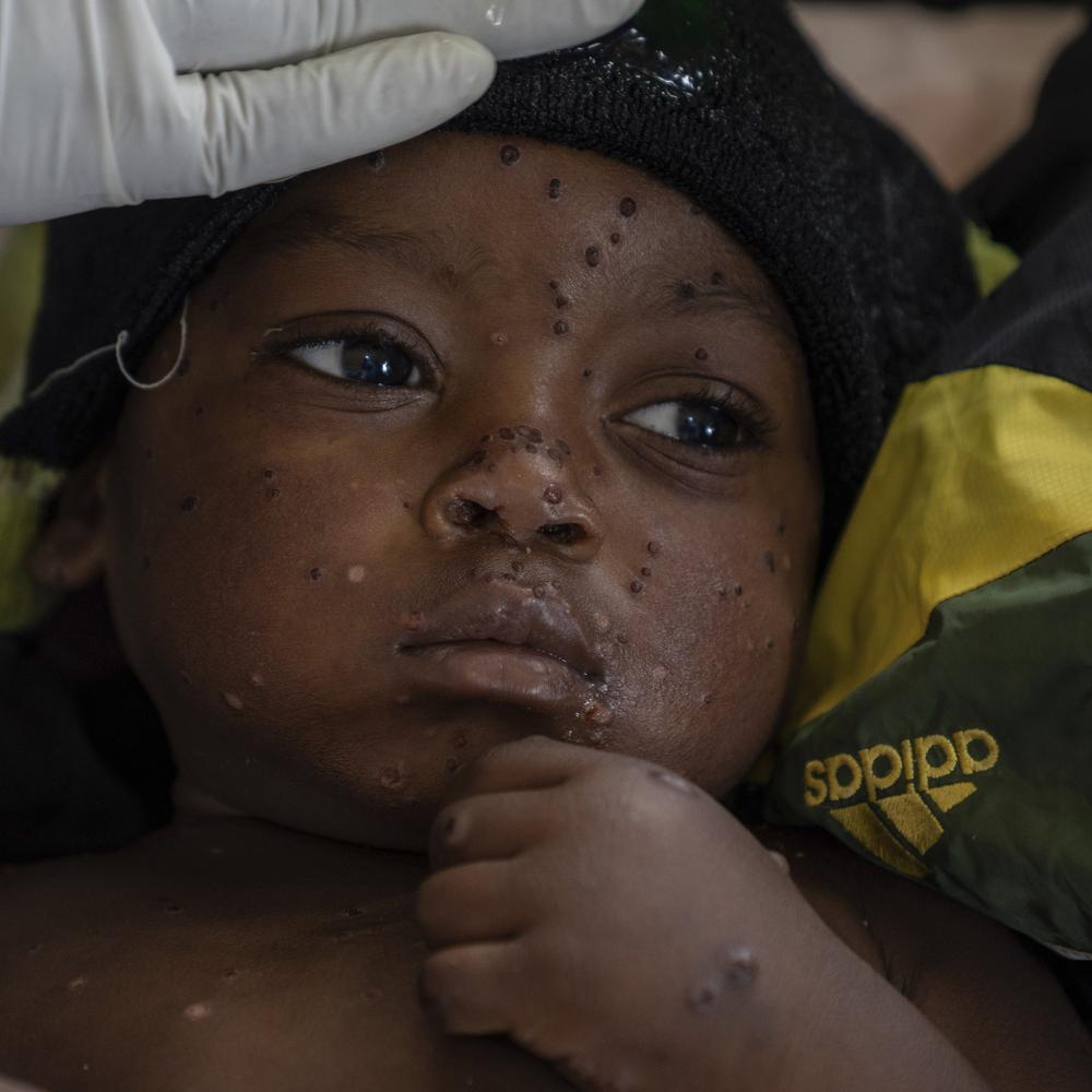 Virus hat Afrika im Griff: Zahl der Mpox-Fälle steigt weiter an