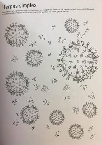 picture of disease for herpes simplex