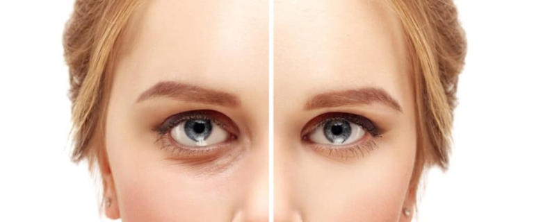 6 Things You Should Know Before Getting Eyelid Surgery