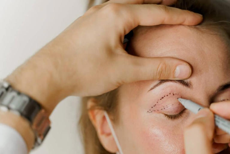 6 Things You Should Know Before Getting Eyelid Surgery