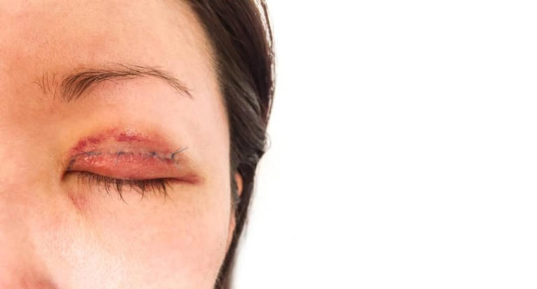 6 Things You Should Know Before Getting Eyelid Surgery