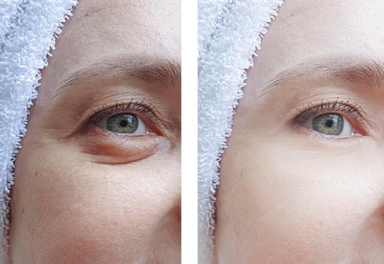 6 Things You Should Know Before Getting Eyelid Surgery