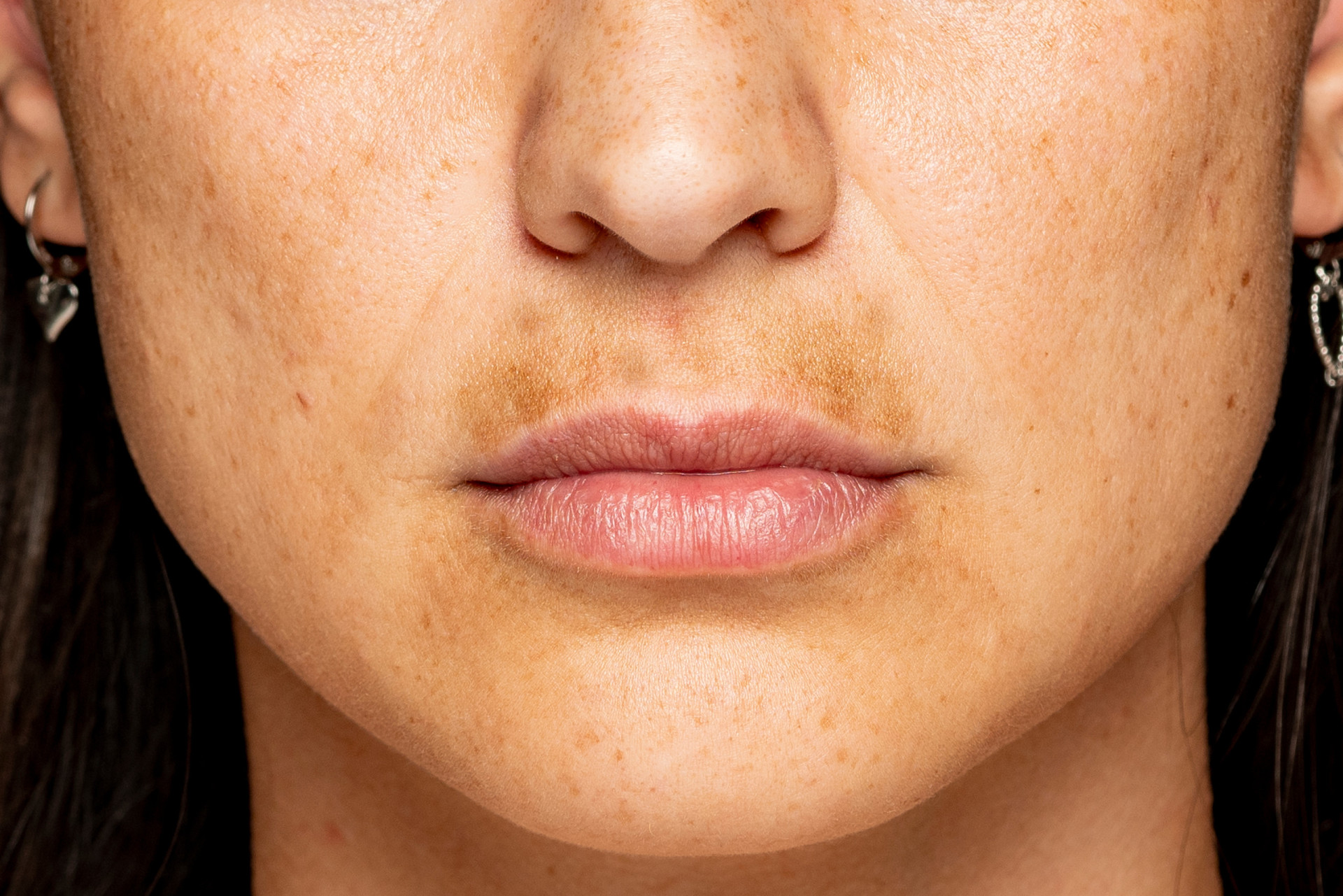 Effective Ways To Treat And Prevent Hyperpigmentation