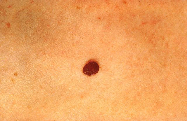 How can you tell if it's melanoma or just a mole?