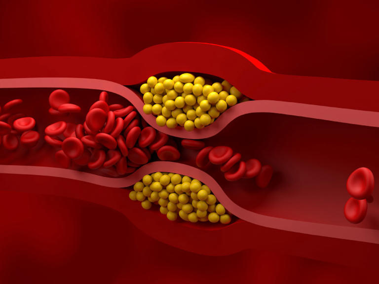 Fluctuating cholesterol in older adults tied to increased dementia risk