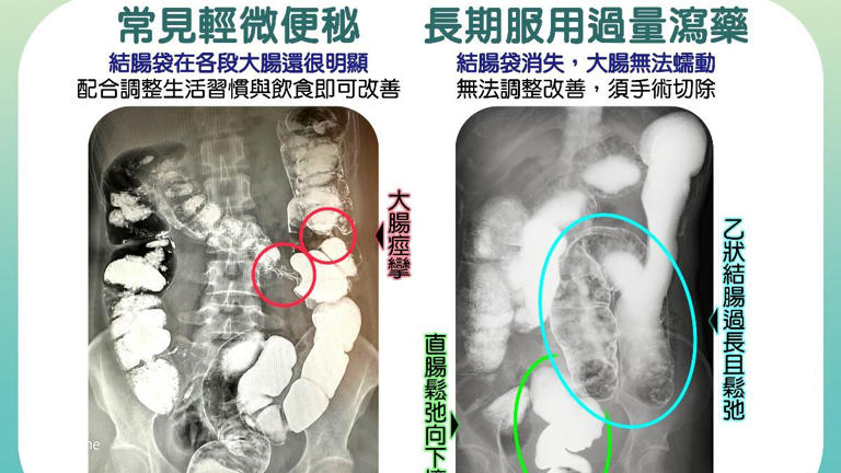 長期過量服用瀉藥的腸道變化，結腸袋消失，無法蠕動，須靠手術解決。（圖／慈濟醫院提供）