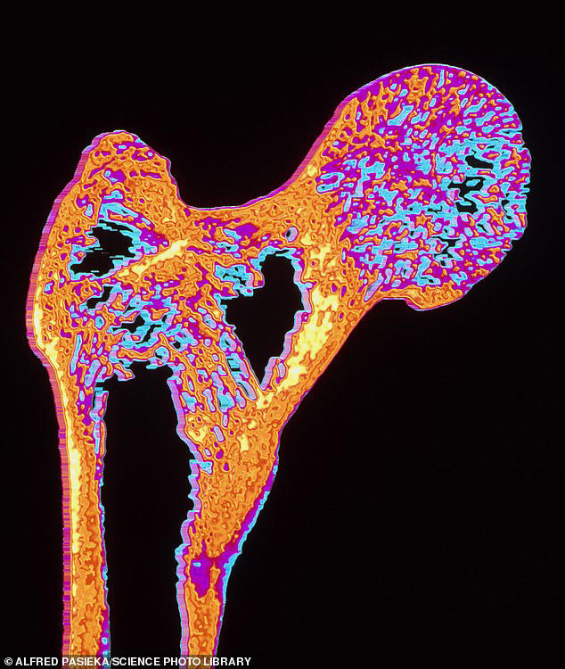 One of UK's most commonly prescribed drugs is linked to bone disease