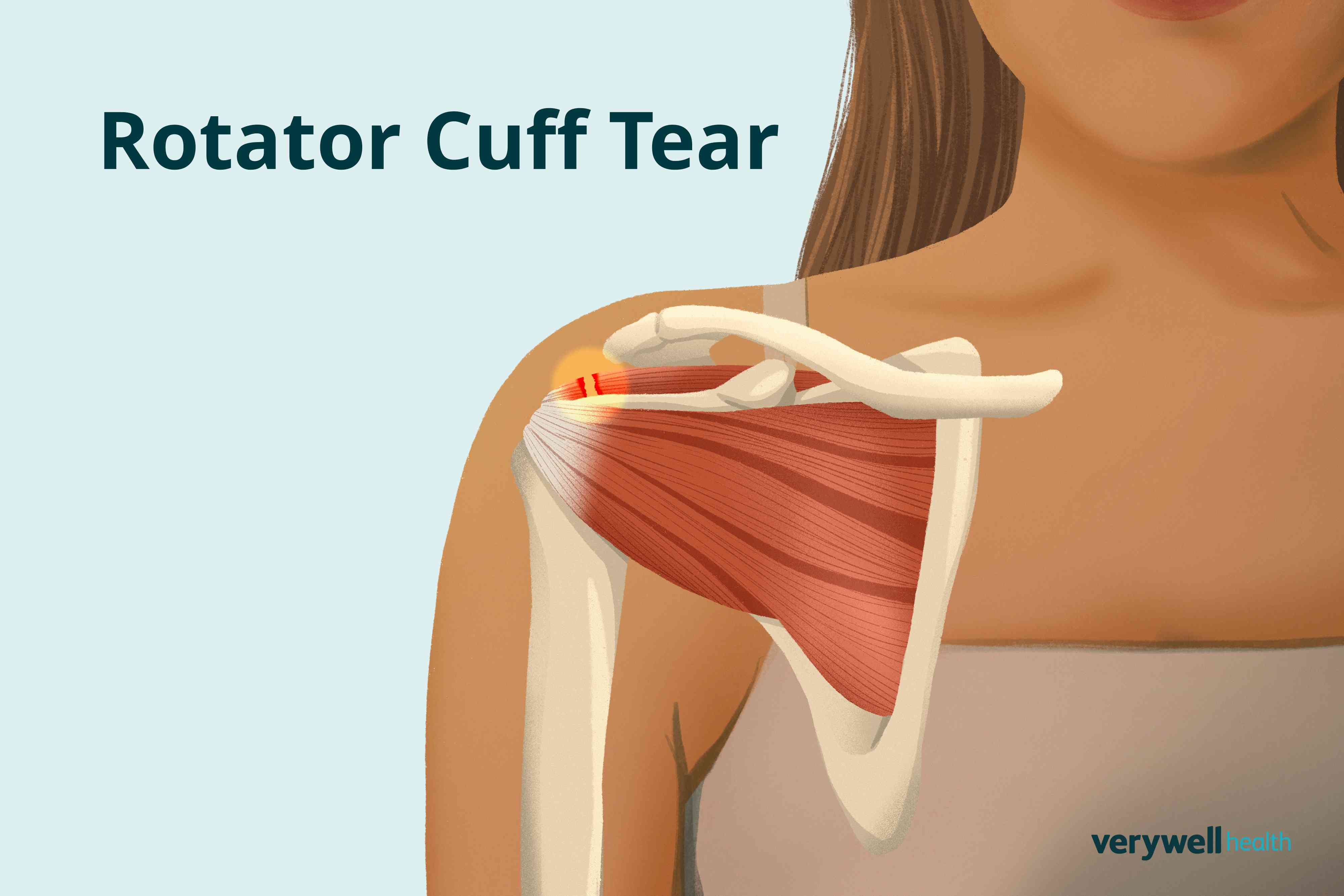 Signs of a rotator cuff tear and how to help it heal