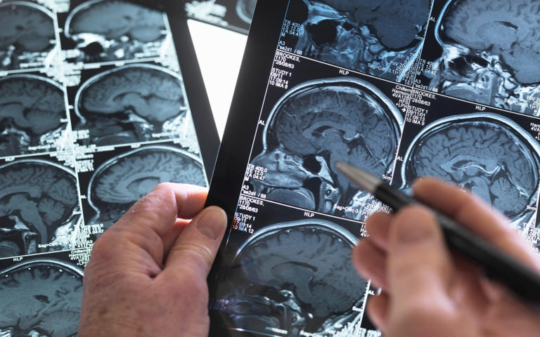 A doctor views a healthy brain scan, but the NHS has warned that a rise in strokes is being fuelled by obesity, poor diet and sedentary lifestyles - Image Source