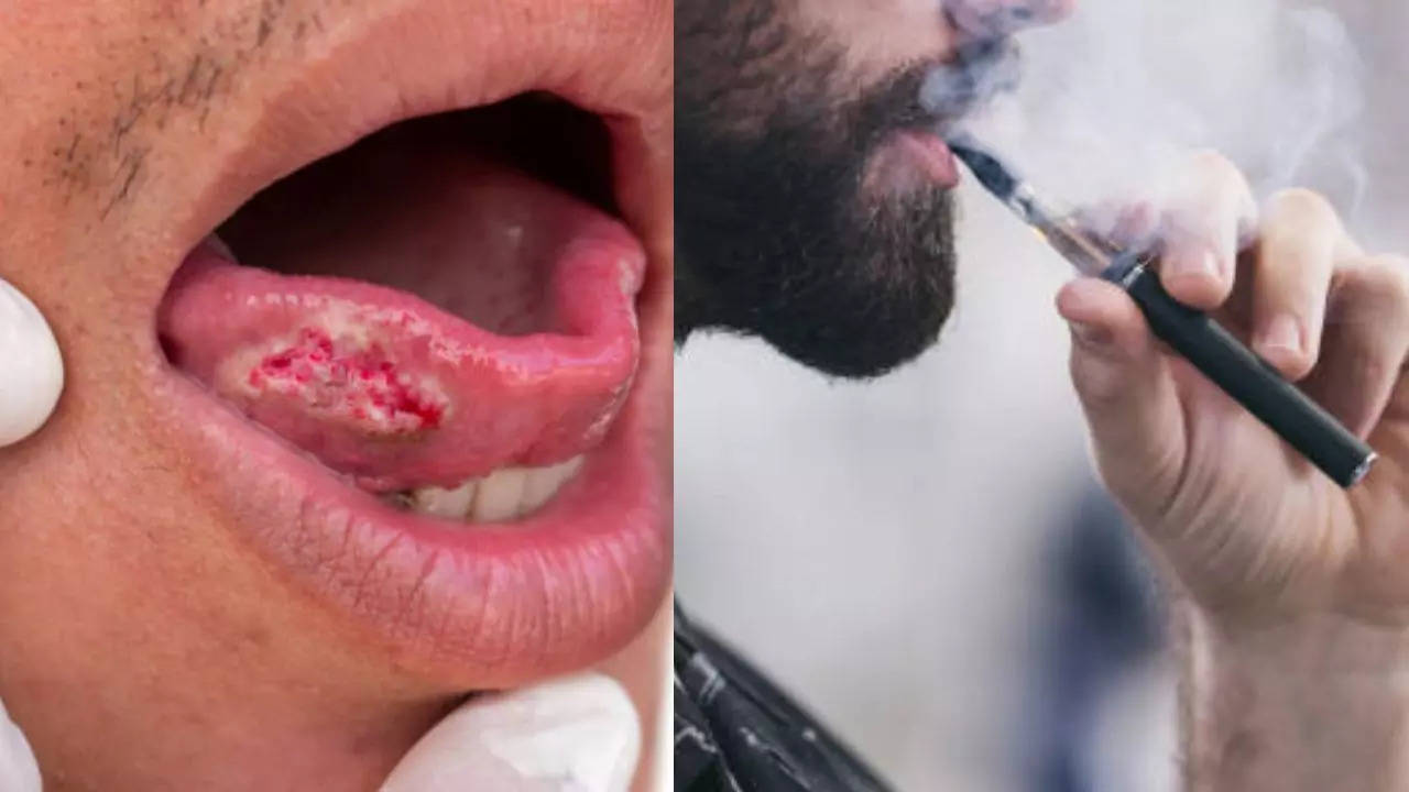 5 Everyday Habits That Increase Your Risk Of Mouth Cancer; Early Signs You Must Never Ignore
