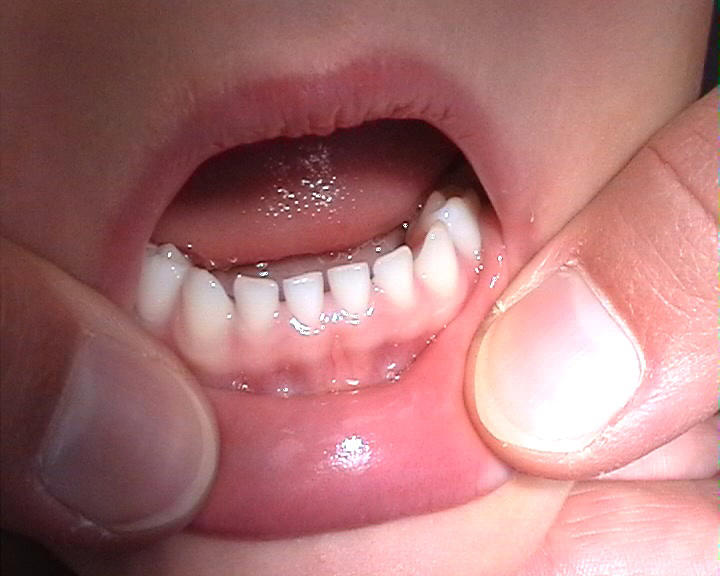 Japanese Scientists Begin Human Trials for Revolutionary Tooth Regrowth