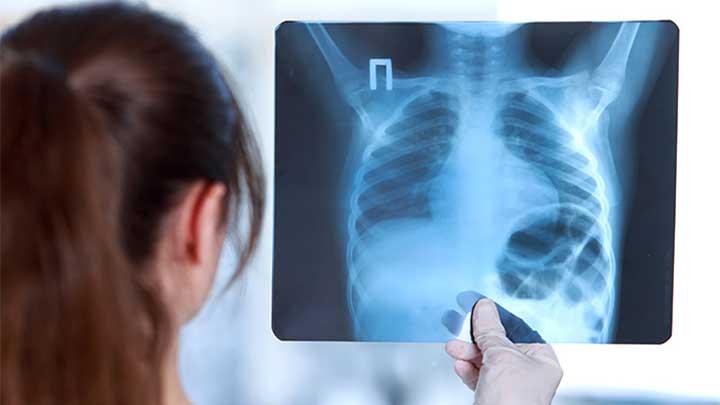 5 Gejala yang Menandakan Paru-Paru Anda Tidak Sehat