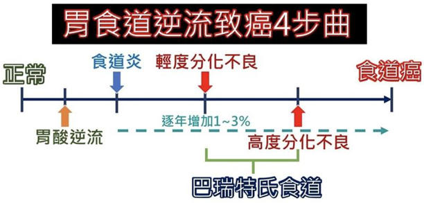 胃食道逆流可能變為巴瑞特氏食道，最終惡化成為食道腺癌。（圖／張靖醫師授權提供）