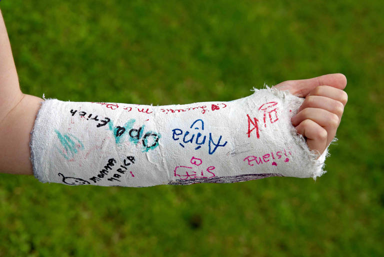 What to know and do about a broken arm
