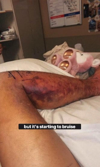 The venomous rattlesnake sunk its teeth into Orin’s leg leaving it swollen and bruised (pictured) (adventorin/Instagram)