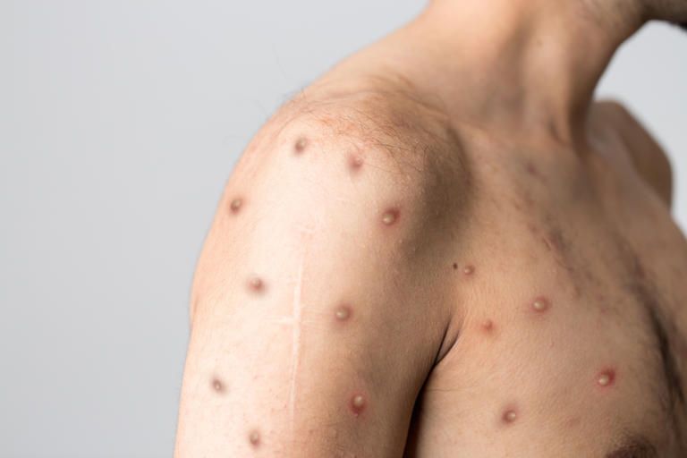 Why You Have a Smallpox Vaccine Scar and What it Means