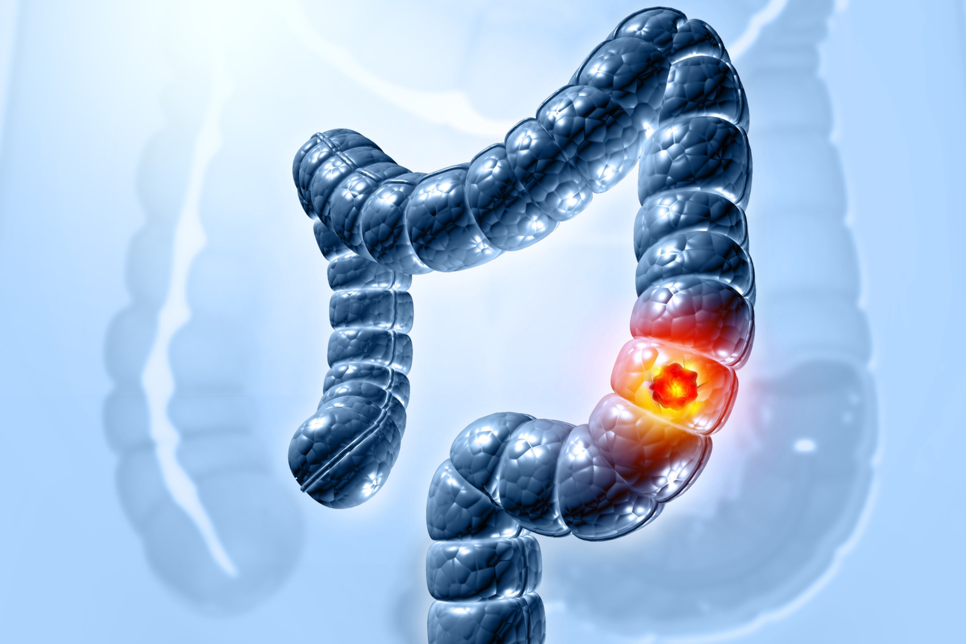 A diagram showing the digestive system with a close-up of the colon and rectum, highlighting potential cancerous growths.