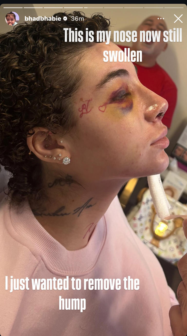 Bhad Bhabie reveals nose job as she clears up rumors about her cancer(02)